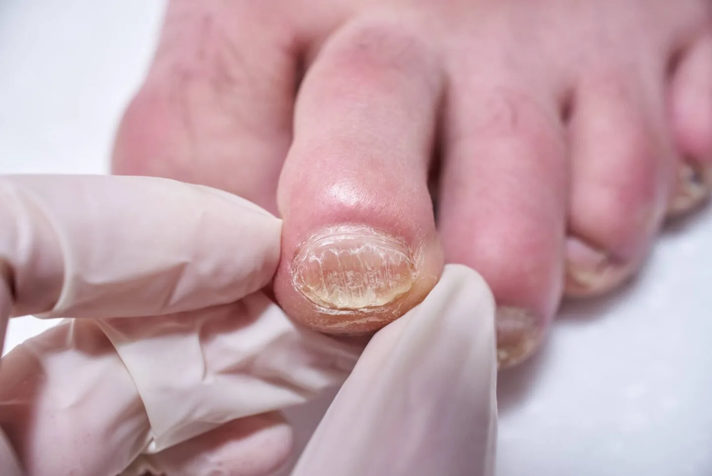 Why Are My Toe Nails Orange? [Toenail Discoloration]