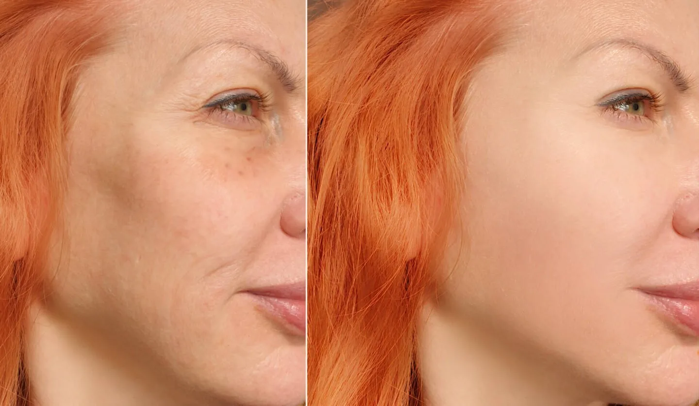 Olive Oil And Baking Soda For Wrinkles Reviews [Bye Fine Lines]