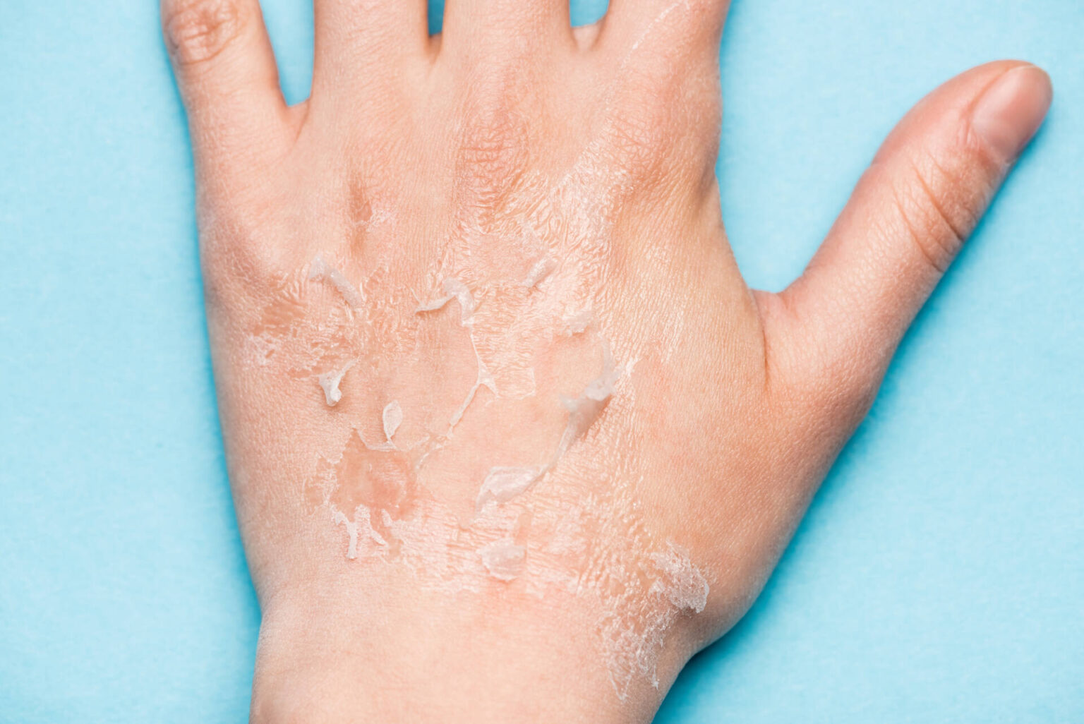 When I Rub My Skin It Rolls Off? Reasons Your Skin Is Rolling Off!