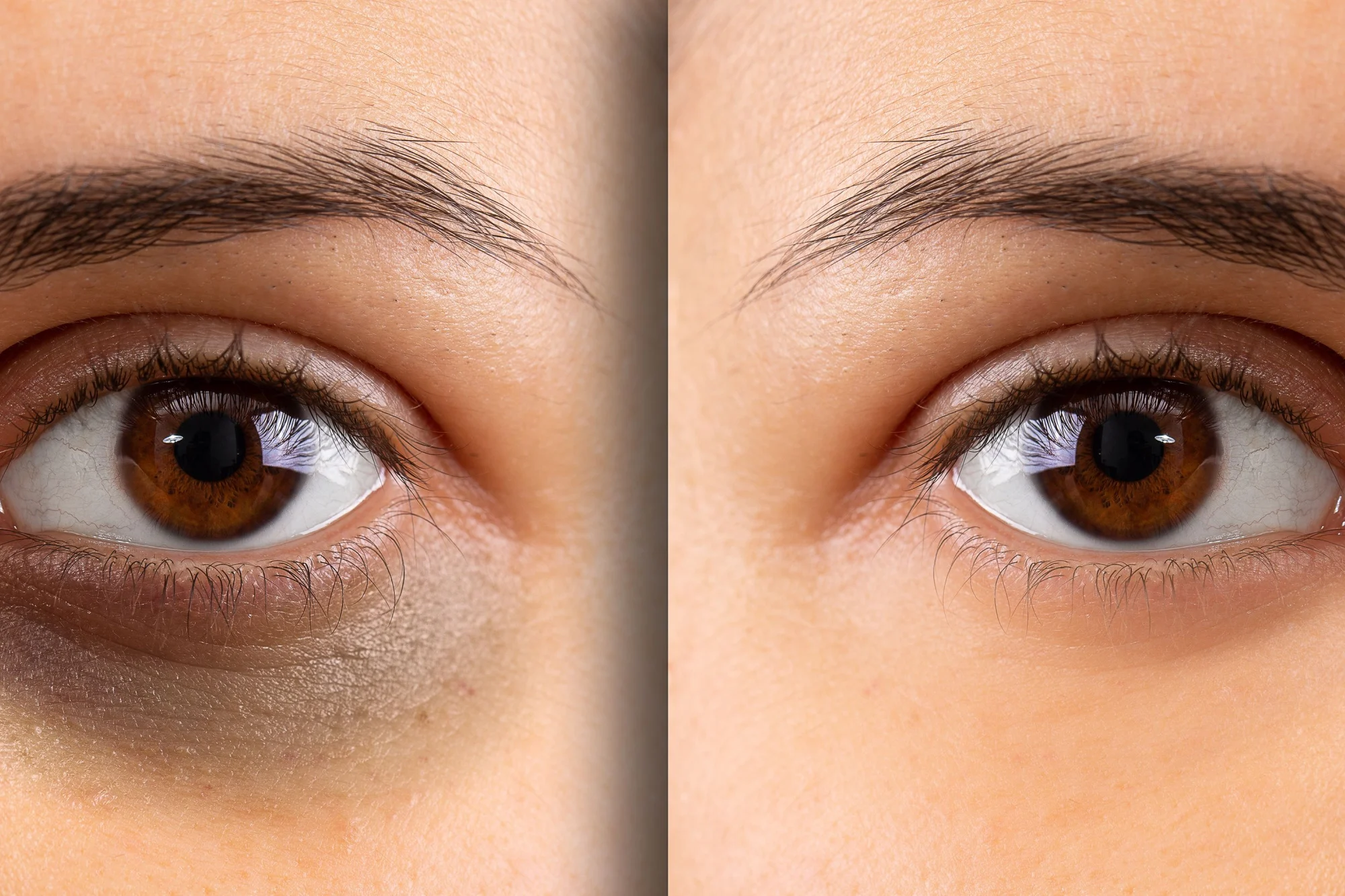How To Fix Under Eye Hollows Without Filler [Bye Sunken Eyes]