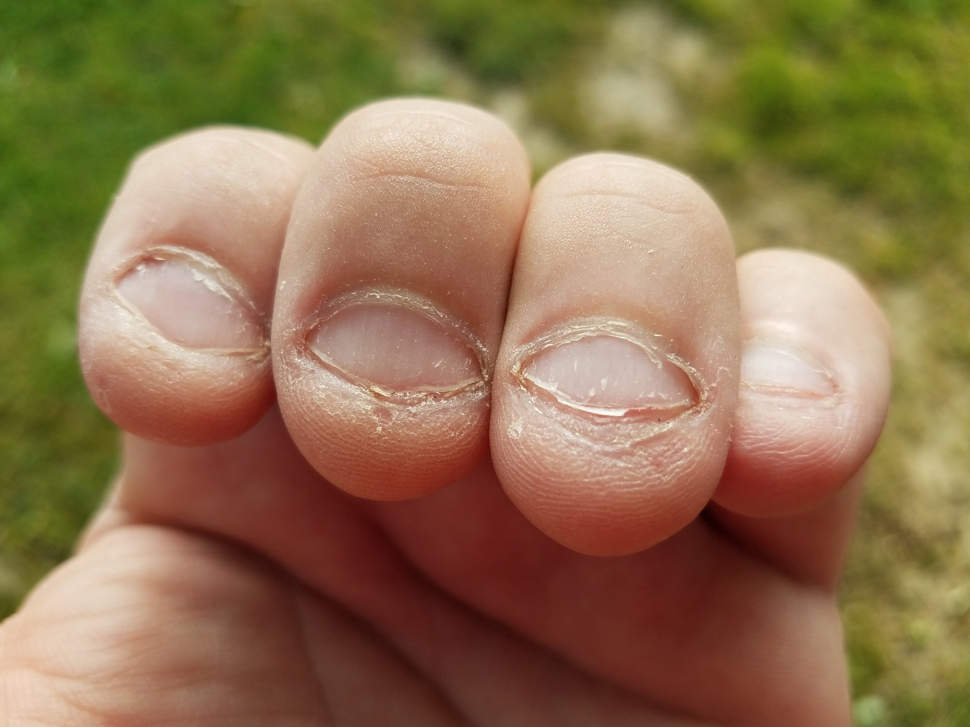 Hope for Nail Biters? Can Bitten Nails Grow Back To Normal?