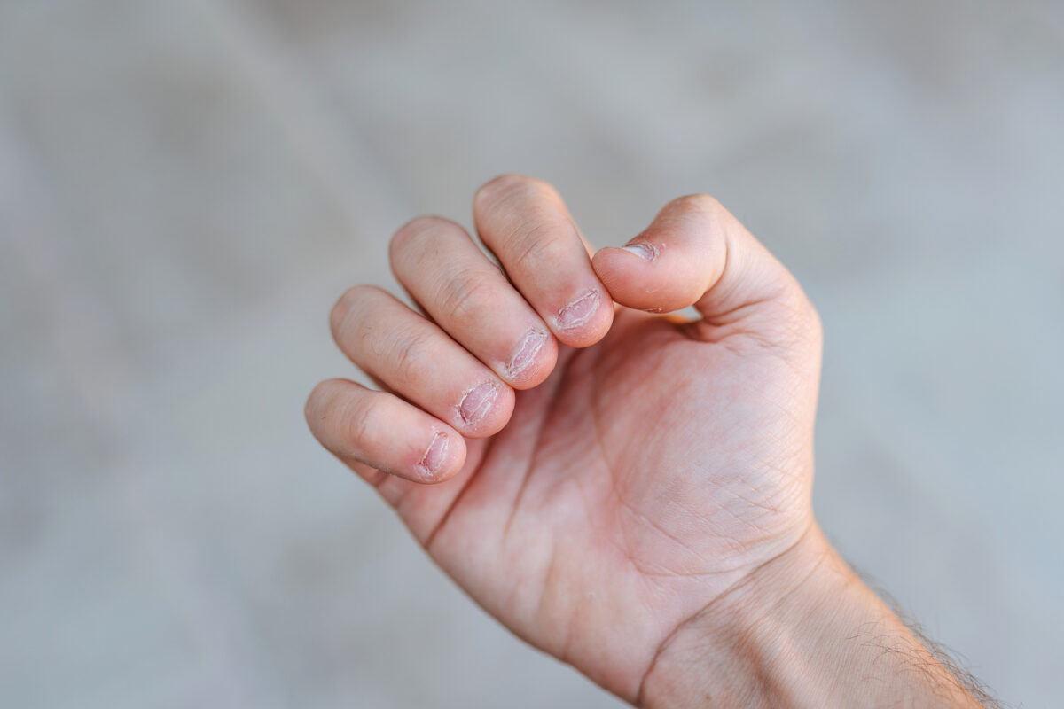 Hope For Nail Biters? Can Bitten Nails Grow Back To Normal?