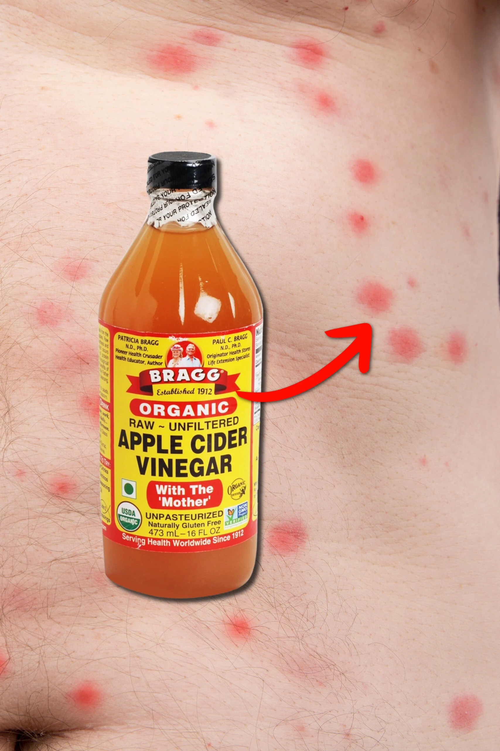 How To Treat Bed Bug Bites Stop The Itch vrogue.co
