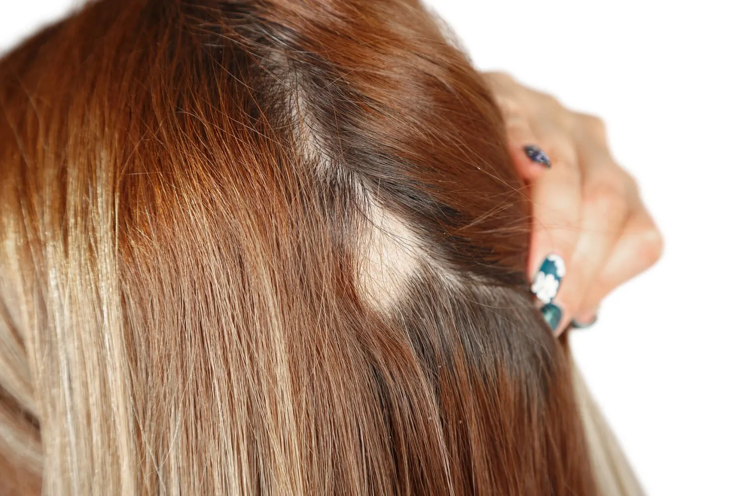 5 Most Common Causes Of Hair Loss In Women