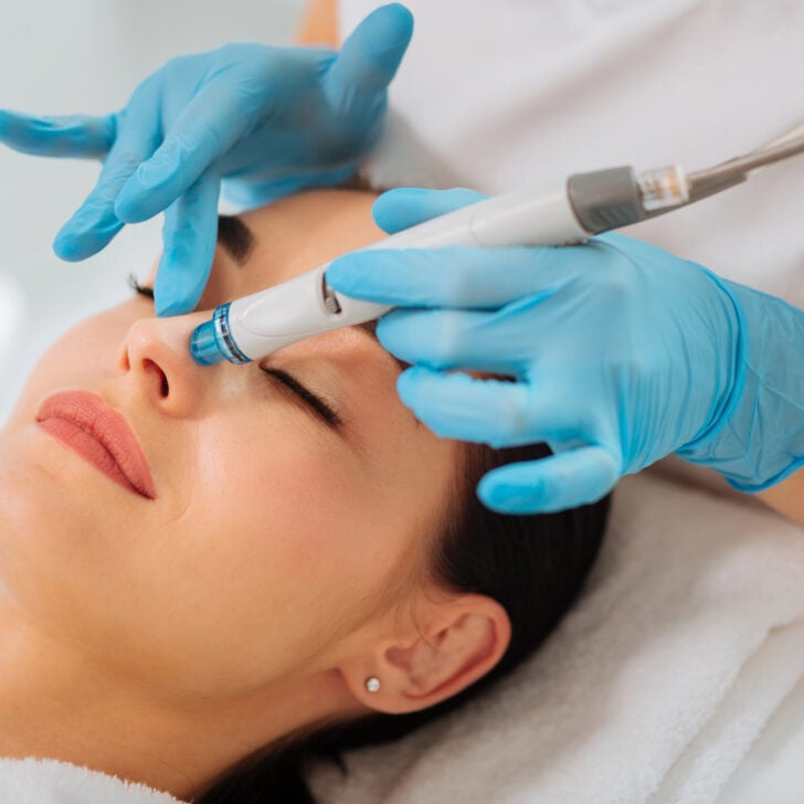 Why Hydrafacials Are Popular for Managing Acne