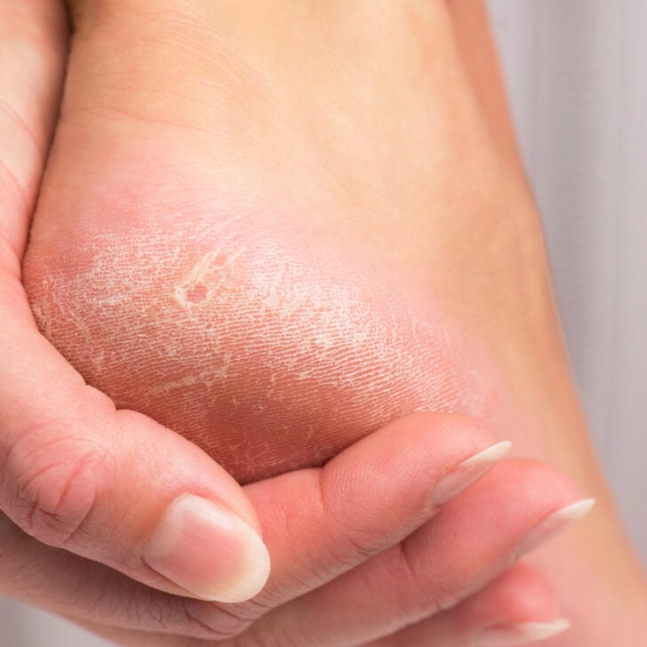 Most Effective Natural Remedies For Cracked Heels