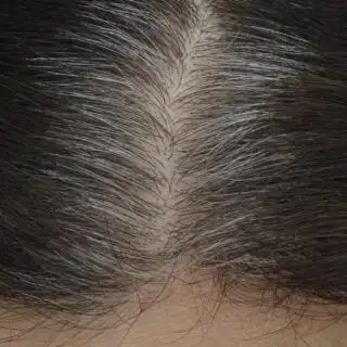 Why Are Grey Hairs Thicker Than Normal Hairs?