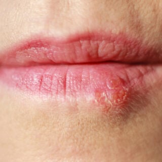 How To Dry Out A Cold Sore Overnight