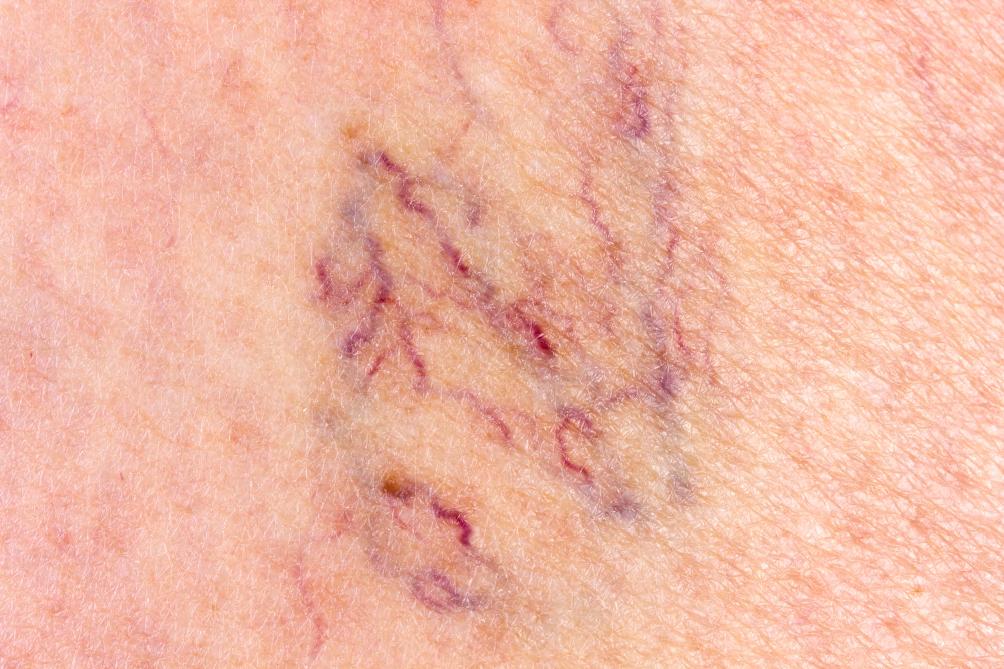 How to Minimise Spider Veins and Improve Skin Confidence
