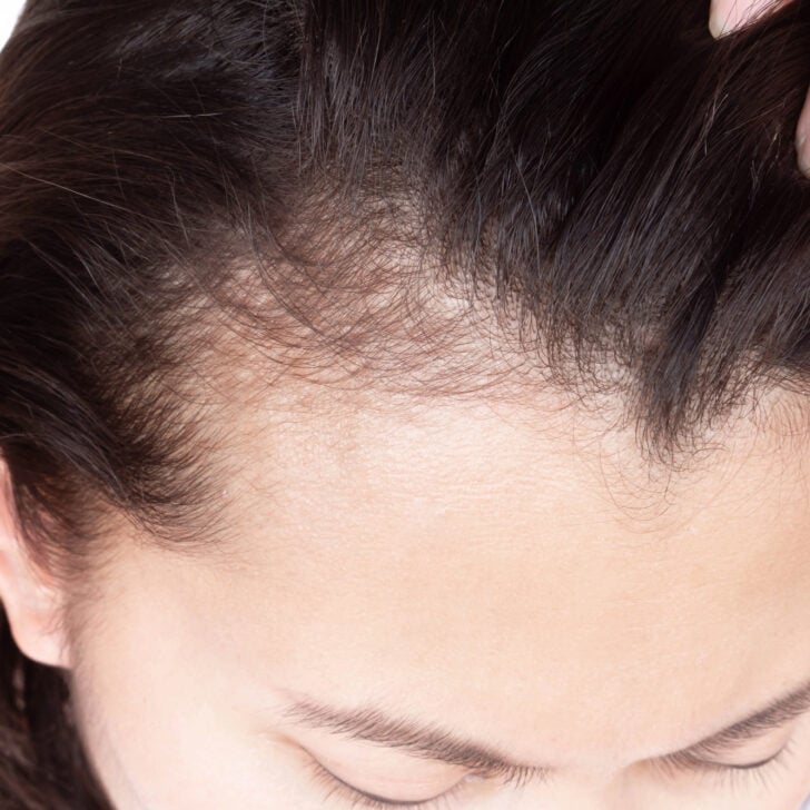 Do Hair Growth Sprays Actually Help With Thinning and Balding?