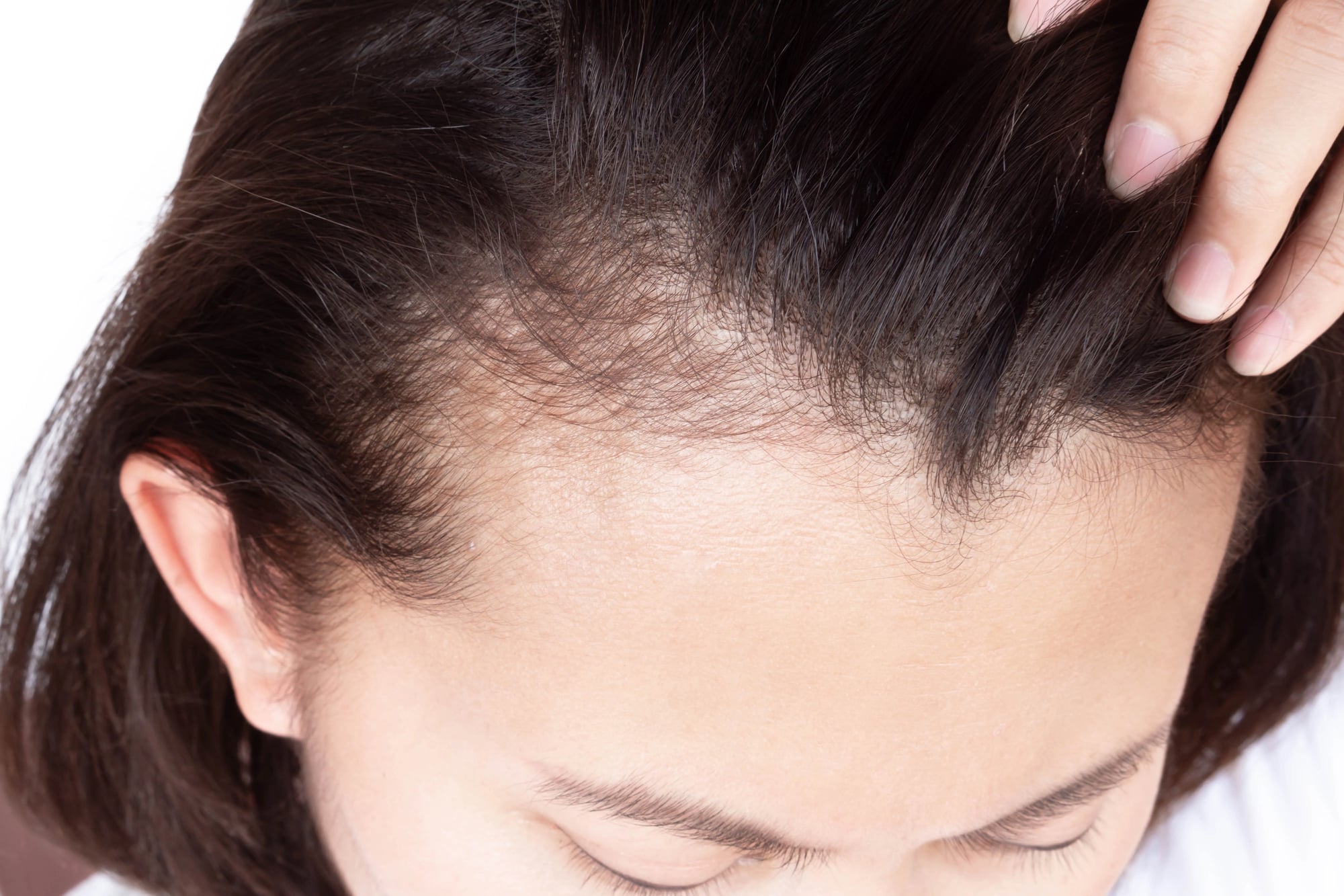 Do Hair Growth Sprays Actually Help With Thinning and Balding?